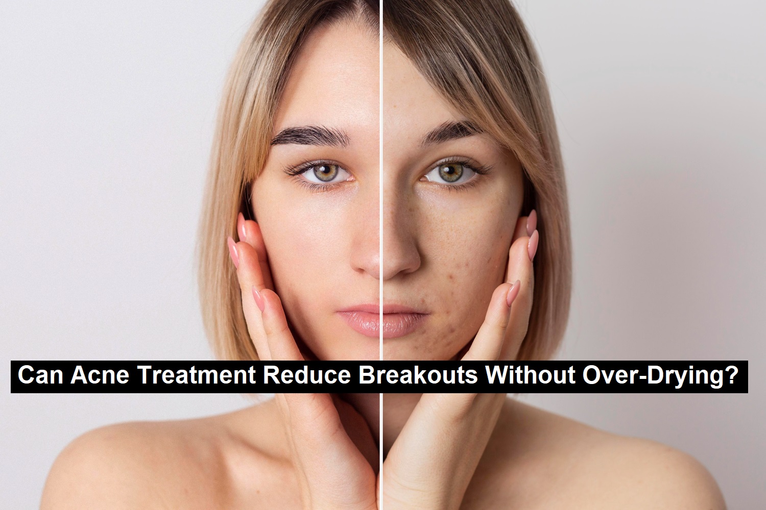 Can Acne Treatment Reduce Breakouts Without Over-Drying?